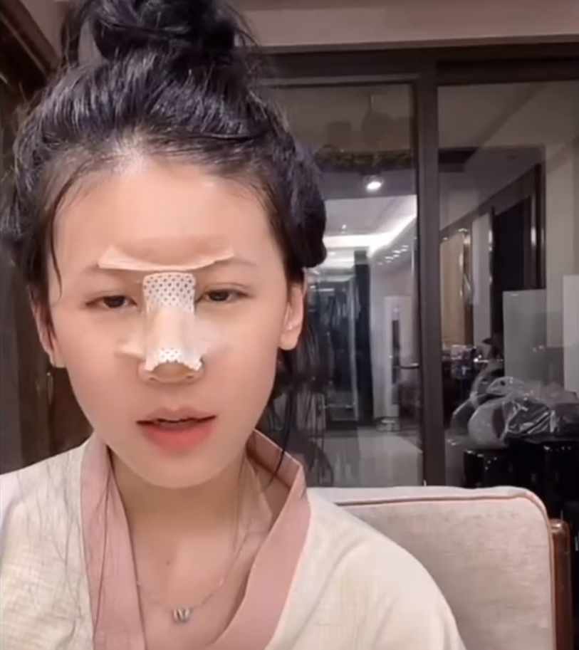 小炸串做完鼻子拆线,网友吐槽太丑了!宇文泡内涵某主播假想敌!(图2) 小炸串做完鼻子拆线,网友吐槽太丑了!宇文泡内涵某主播假想敌!(图2)