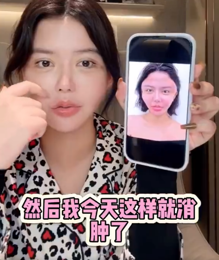 韩安冉产后一月就整容,大方晒出打针后的照片,整个脸都变形了(图6) 韩安冉产后一月就整容,大方晒出打针后的照片,整个脸都变形了(图6)