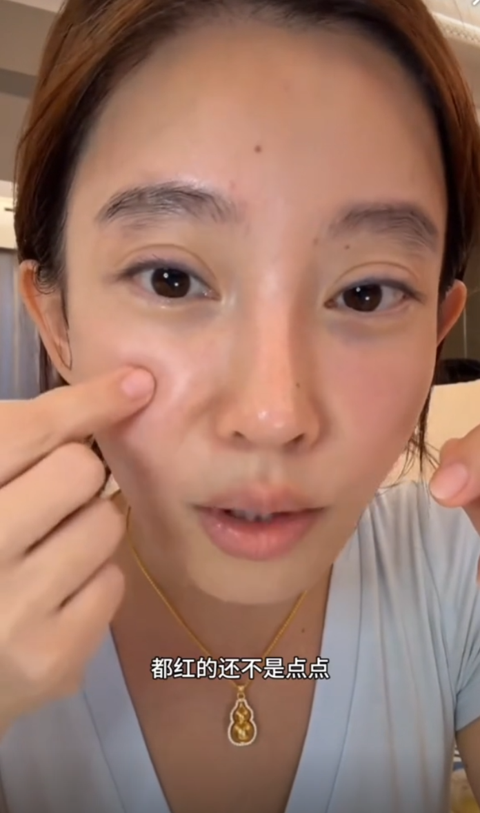 一毛钱的面膜敢用吗,我就敢!冯提莫讲述因捡便宜变成“激素脸”(图5) 一毛钱的面膜敢用吗,我就敢!冯提莫讲述因捡便宜变成“激素脸”(图5)