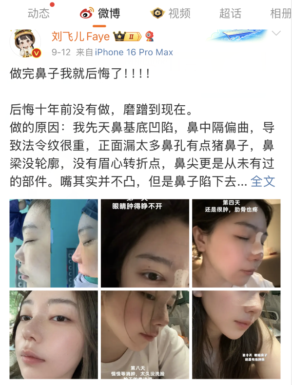 刘飞儿发文后悔整容?十年心结一朝解,坦言后悔没早去做鼻子(图2) 刘飞儿发文后悔整容?十年心结一朝解,坦言后悔没早去做鼻子(图2)