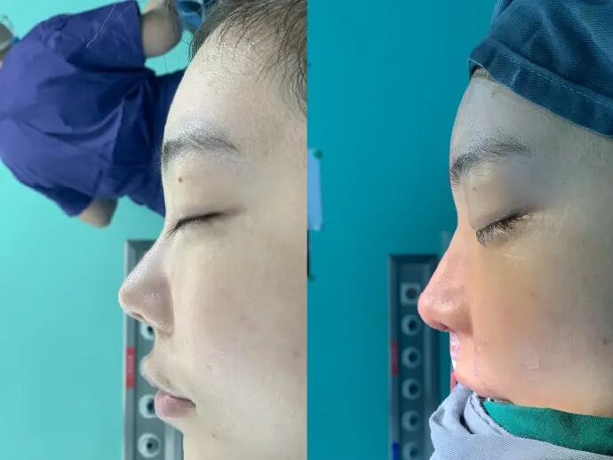 刘飞儿发文后悔整容?十年心结一朝解,坦言后悔没早去做鼻子(图3) 刘飞儿发文后悔整容?十年心结一朝解,坦言后悔没早去做鼻子(图3)