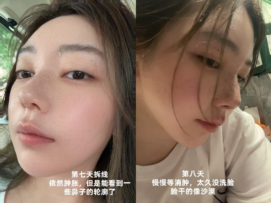 刘飞儿发文后悔整容?十年心结一朝解,坦言后悔没早去做鼻子(图4) 刘飞儿发文后悔整容?十年心结一朝解,坦言后悔没早去做鼻子(图4)
