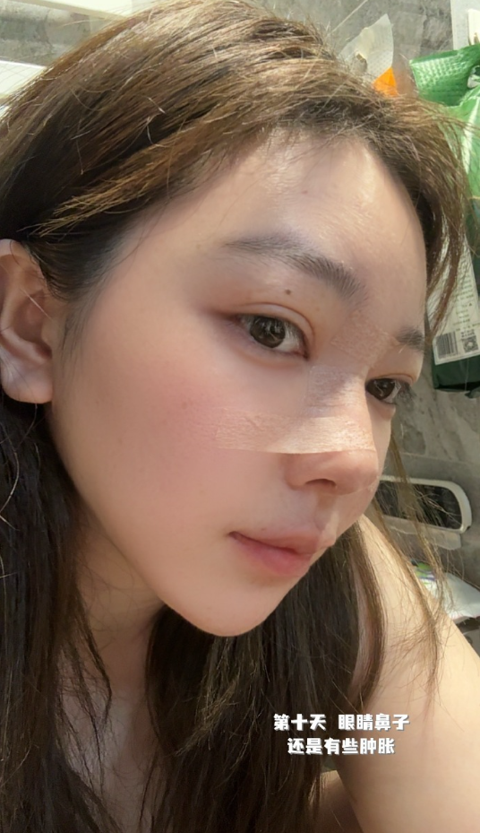 刘飞儿发文后悔整容?十年心结一朝解,坦言后悔没早去做鼻子(图6) 刘飞儿发文后悔整容?十年心结一朝解,坦言后悔没早去做鼻子(图6)